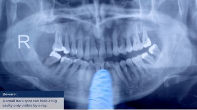 The removable dental prosthesis